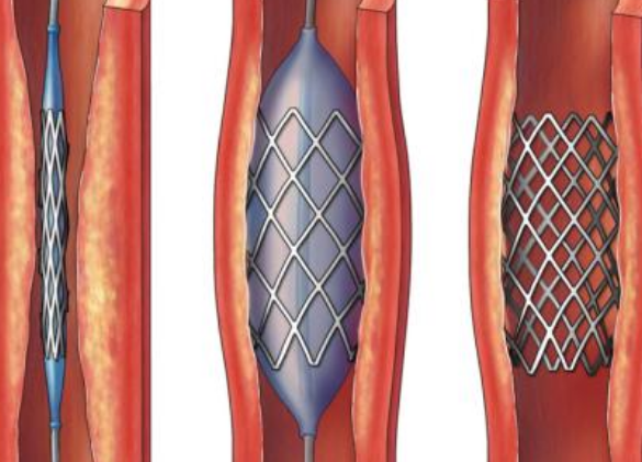 好消息！700元冠脈支架來了帶量采購結(jié)果在甘肅省正式落地執(zhí)行